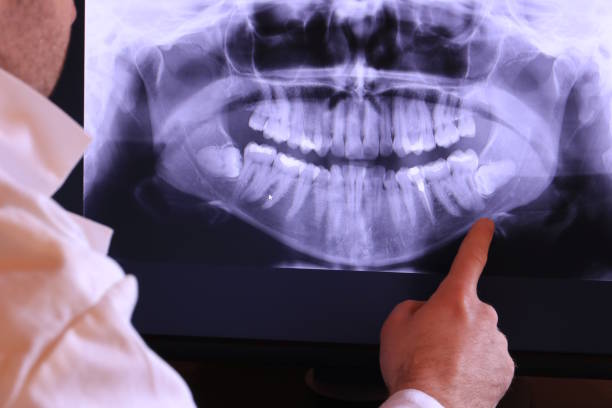 Best Emergency Wisdom Tooth Extraction in Del Monte Forest, CA